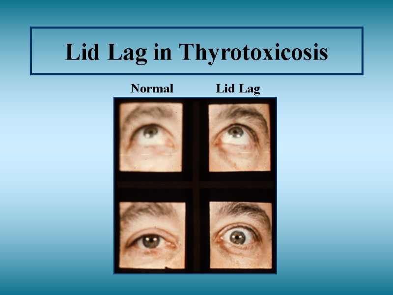 Lid Lag in Thyrotoxicosis Normal   Lid Lag